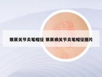 银屑关节炎笔帽征 银屑病关节炎笔帽征图片