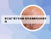 职工在厂得了牛皮癣 有牛皮病癣可以生孩子吗