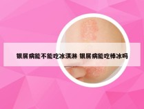 银屑病能不能吃冰淇淋 银屑病能吃棒冰吗