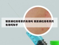 银屑病吃排毒草药有用吗 银屑病吃排毒草药有用吗知乎