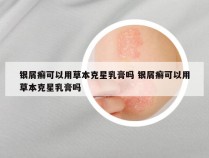 银屑癣可以用草本克星乳膏吗 银屑癣可以用草本克星乳膏吗