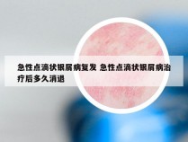 急性点滴状银屑病复发 急性点滴状银屑病治疗后多久消退