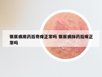 银屑病用药后奇痒正常吗 银屑病抹药后痒正常吗