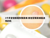 3个月宝宝脓疱型银屑病 脓包型银屑病是遗传的吗