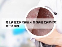 男士两腿之间长癣图片 男性两腿之间长红斑是什么原因