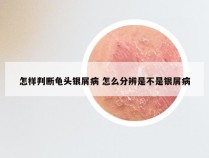 怎样判断龟头银屑病 怎么分辨是不是银屑病