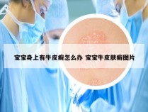 宝宝身上有牛皮癣怎么办 宝宝牛皮肤癣图片