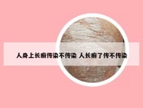 人身上长癣传染不传染 人长癣了传不传染