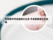 牛皮癣平时洗澡用什么洗 牛皮肤癣拿什么洗澡