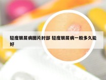 轻度银屑病图片肘部 轻度银屑病一般多久能好