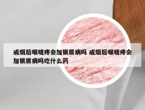 戒烟后喉咙疼会加银屑病吗 戒烟后喉咙疼会加银屑病吗吃什么药