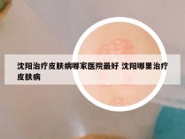 沈阳治疗皮肤病哪家医院最好 沈阳哪里治疗皮肤病