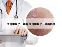 大腿根长了一块癣 大腿根长了一块癣很痒