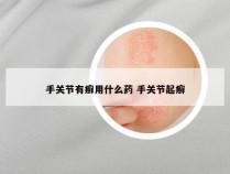 手关节有癣用什么药 手关节起癣