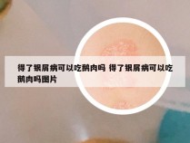 得了银屑病可以吃鹅肉吗 得了银屑病可以吃鹅肉吗图片