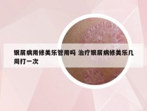 银屑病用修美乐管用吗 治疗银屑病修美乐几周打一次