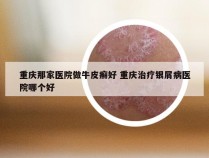 重庆那家医院做牛皮癣好 重庆治疗银屑病医院哪个好