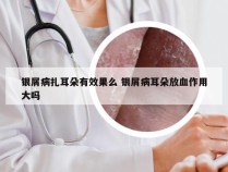 银屑病扎耳朵有效果么 银屑病耳朵放血作用大吗