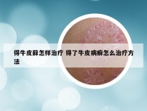 得牛皮藓怎样治疗 得了牛皮病癣怎么治疗方法