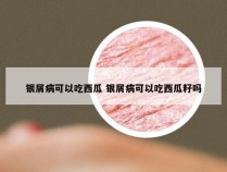 银屑病可以吃西瓜 银屑病可以吃西瓜籽吗