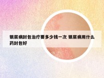 银屑病封包治疗要多少钱一次 银屑病用什么药封包好