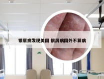 银屑病发现美国 银屑病国外不算病