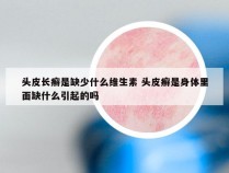 头皮长癣是缺少什么维生素 头皮癣是身体里面缺什么引起的吗