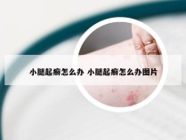 小腿起癣怎么办 小腿起癣怎么办图片