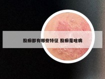 股癣都有哪些特征 股癣是啥病