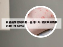 银屑病生物制剂要一直打针吗 银屑病生物制剂要打多长时间