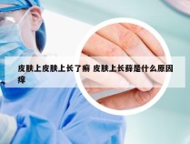 皮肤上皮肤上长了癣 皮肤上长藓是什么原因痒