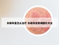 白癣风是怎么治疗 白癣风皮肤病图片大全