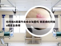 吃阿维A胶囊牛皮癣会加重吗 银屑病吃阿维a爆皮全身痒