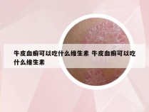 牛皮血癣可以吃什么维生素 牛皮血癣可以吃什么维生素