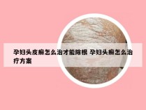 孕妇头皮癣怎么治才能除根 孕妇头癣怎么治疗方案