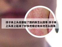 孩子身上头皮都起了圆的藓怎么回事 孩子身上头皮上起来了好多疙瘩还有水泡怎么回事