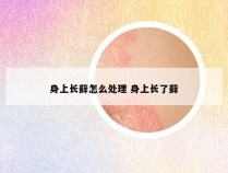 身上长藓怎么处理 身上长了藓