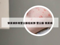 银屑病停用雷公藤后反弹 雷公藤 银屑病