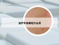 治疗牛皮癣吃什么药