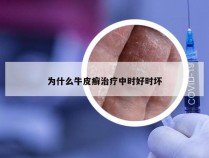 为什么牛皮癣治疗中时好时坏