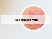 上海白癜风治疗医院最好