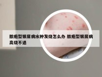 脓疱型银屑病水肿发烧怎么办 脓疱型银屑病高烧不退