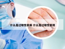 什么是过敏性紫癣 什么是过敏性紫斑