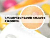 急性点滴型牛皮癣咋治好的快 急性点滴状银屑病可以自愈吗