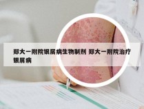 郑大一附院银屑病生物制剂 郑大一附院治疗银屑病