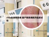 cfda批准银屑病 国产银屑病新药临床试验