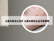 儿童头藓怎么治疗 儿童头癣怎么治才能断根