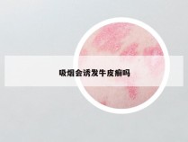 吸烟会诱发牛皮癣吗