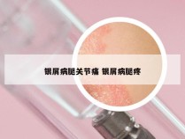 银屑病腿关节痛 银屑病腿疼