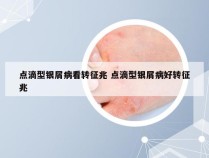 点滴型银屑病看转征兆 点滴型银屑病好转征兆